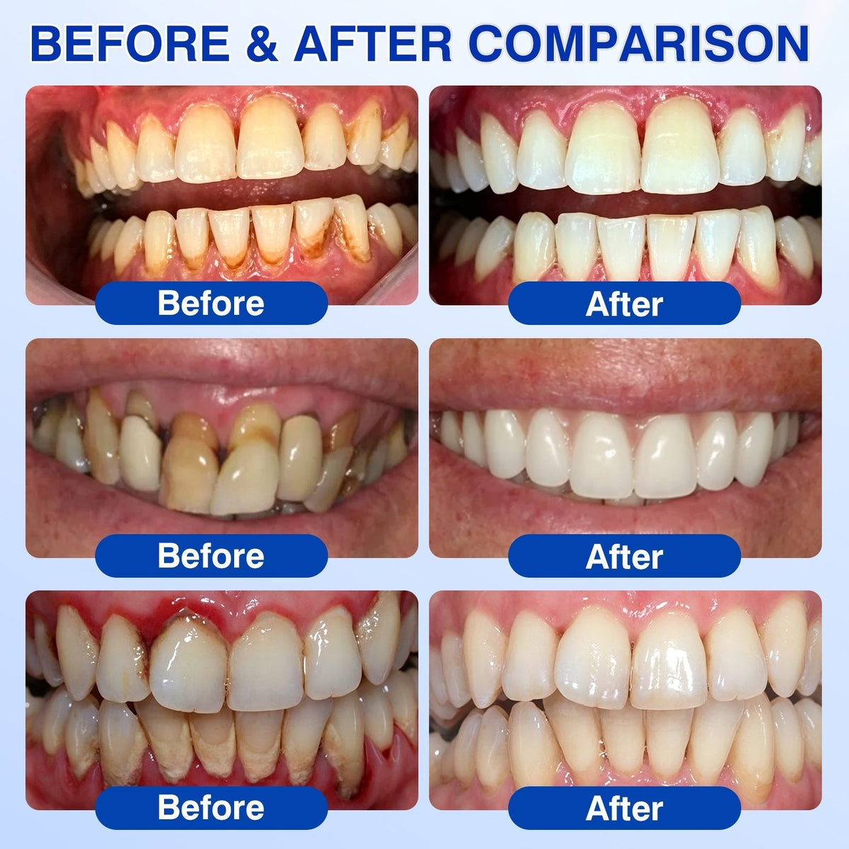 🦷 PERIVA Advanced Gum Care Gel – Tägliche Pflege für frischen Atem & gepflegtes Zahnfleisch