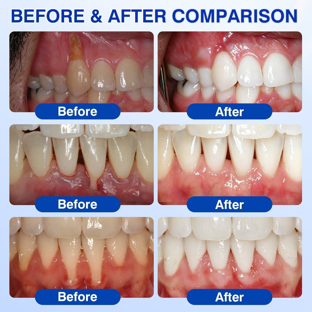 🦷 PERIVA Advanced Gum Care Gel – Tägliche Pflege für frischen Atem & gepflegtes Zahnfleisch